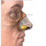 Septumrinoplastía